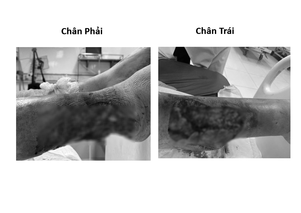 Lóc da cẳng chân do tai nạn – Cảnh báo biến chứng ở bệnh nhân đái tháo đường