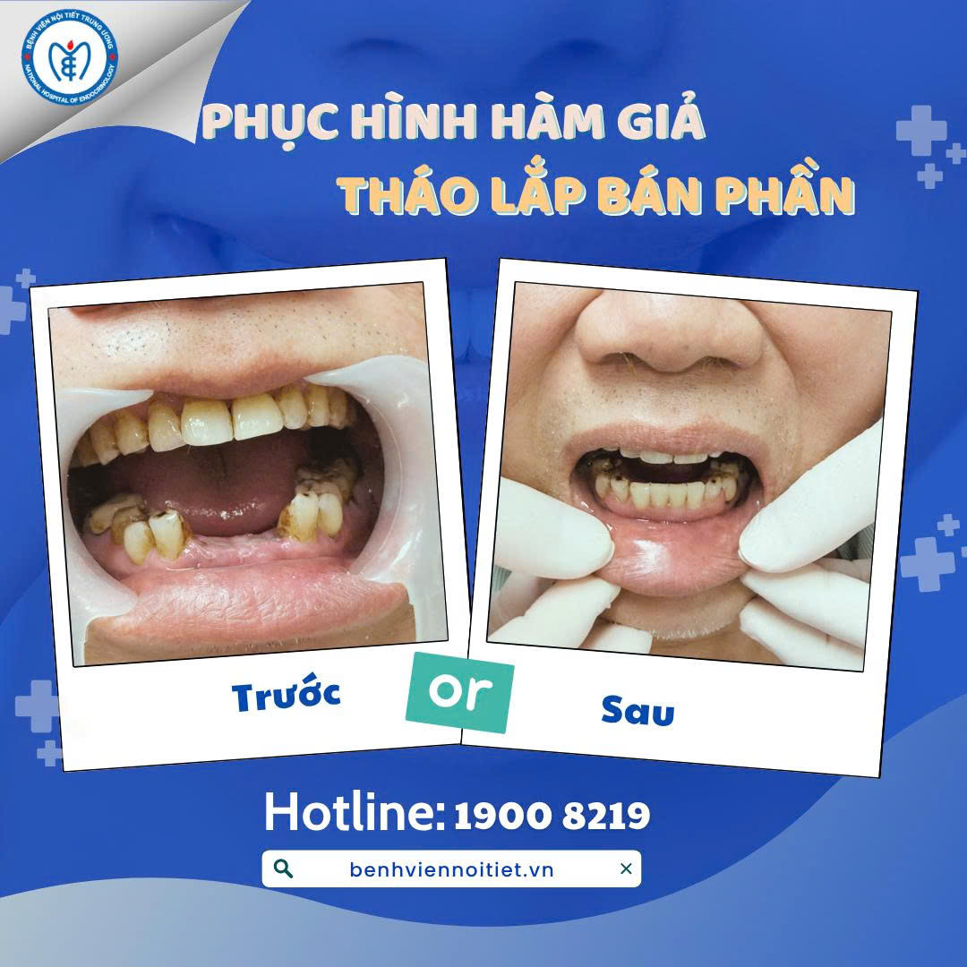Điều trị an toàn cho người bệnh có bệnh lý nền: Hành trình phục hồi nụ cười tại Bệnh viện Nội tiết Trung ương