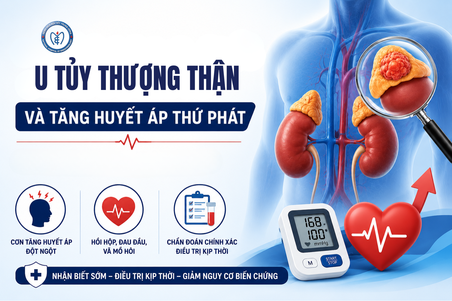 U tủy thượng thận (pheochromocytoma) và tăng huyết áp thứ phát