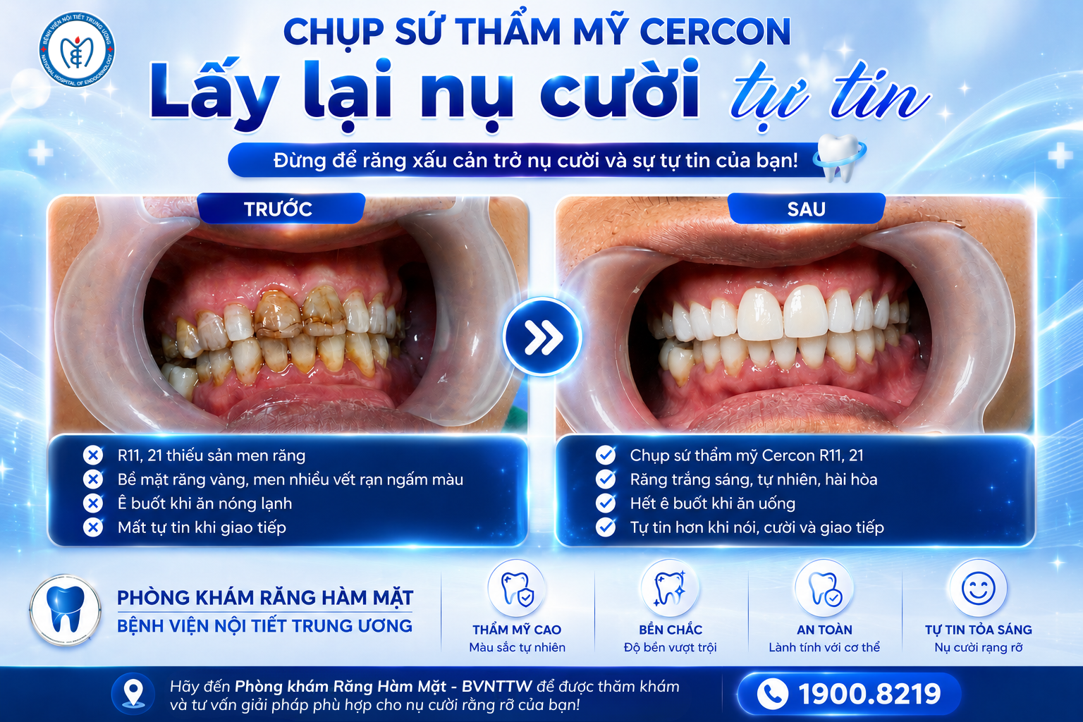 Đừng để hàm răng kém thẩm mỹ cản trở nụ cười và sự tự tin của bạn