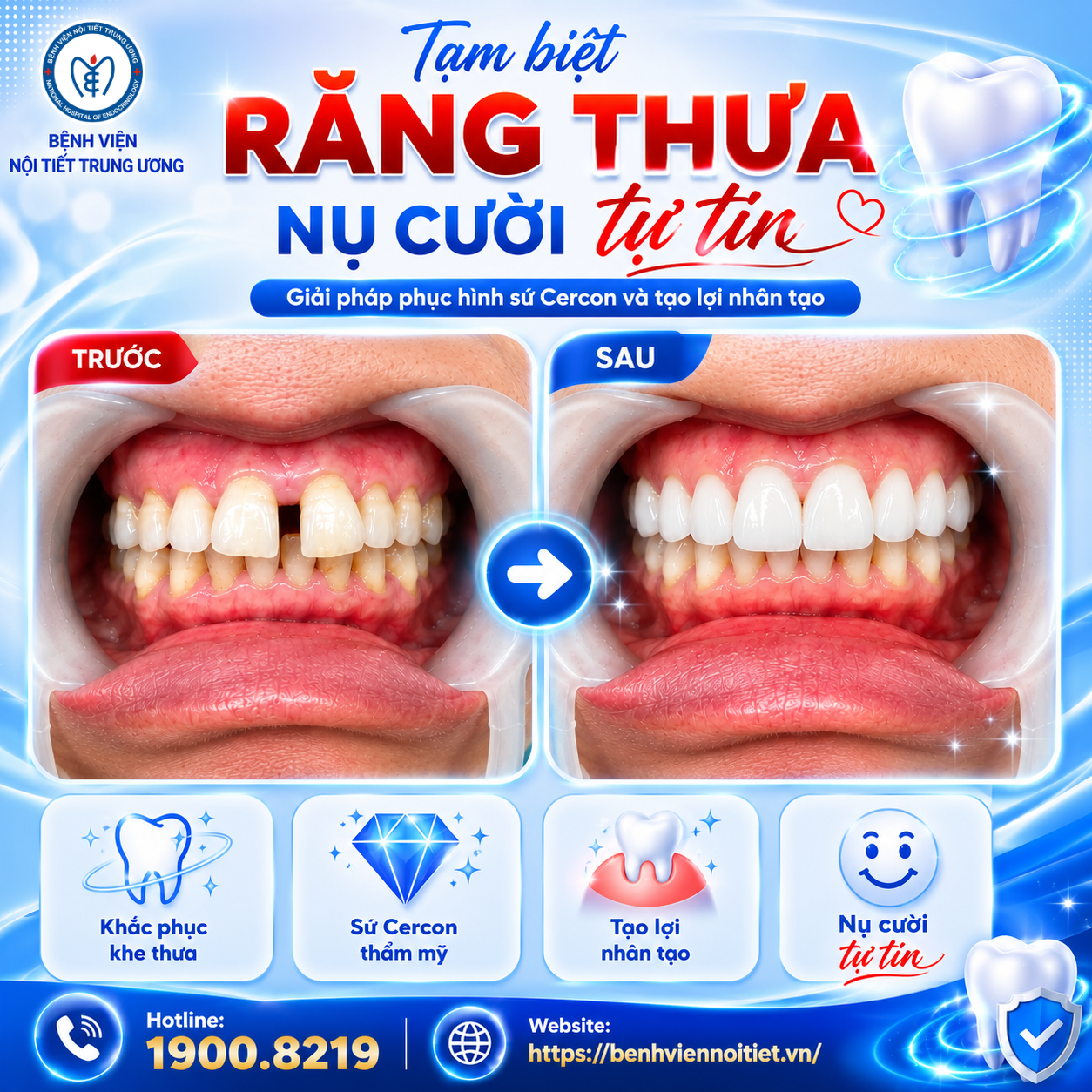Răng thưa không chỉ ảnh hưởng thẩm mỹ – Giải pháp phục hình sứ Cercon giúp người bệnh lấy lại nụ cười tự tin